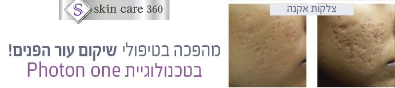 צלקות אקנה